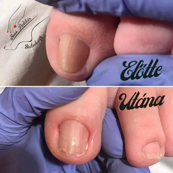 Körömkezelés, előtte és utána